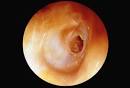 ♀ my life as a cutter ♀: Tarivid is in my ear