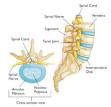 A herniated disk (side view