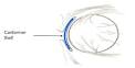 The Operation: Eye Enucleation, Fitting of the Orbital Implant and ...