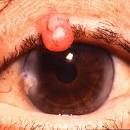 <b>APUDoma</b> - cutaneous. Overview