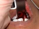 Direct <b>laryngoscopy</b>. Grade I