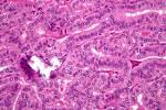 File:<b>Papillary</b> thyroid