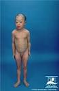 <b>Ichthyosiform Erythroderma</b>