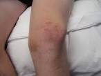 <b>Patella Dislocation</b>