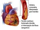<b>Infarto</b> Agudo <b>do Miocárdio</b>