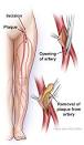 Endarterectomy