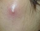 abscess