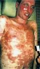 dalla <b>sindrome di stevens</b>