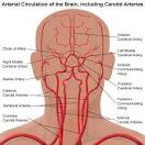 Carotid Artery Disease - New York Presbyterian Hospital