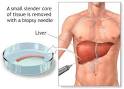 HCV - Liver Biopsy