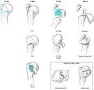Classification. Neer