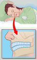 Bruxism: Signs And Symptoms
