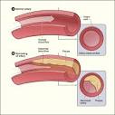 Atherosclerosis can lead to