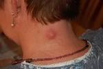 File:Inflamed epidermal inclusion cyst.jpg - Wikipedia, the free ...