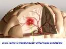 l'<b>emorragia</b> cerebrale