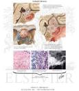 <b>Acidophil Adenoma</b>