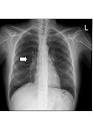 <b>Mediastinitis</b>