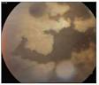 <b>retinal necrosis syndrome</b>