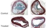 PENN Medicine News Photo: Inhibiting Cholesterol-Associated ...