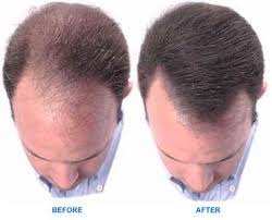 Hair Loss Treatment