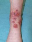 <b>pyoderma gangrenosum</b>