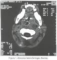 <b>absceso</b> (figuras # 1 y 2).