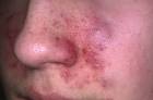 Seborrheic Dermatitis Pictures, Causes, Symptoms, Treatment and Cure