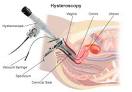What Is Hysteroscopy?