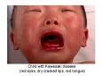 KAWASAKI DISEASE