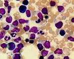 blastic <b>plasmacytic</b> dendritic