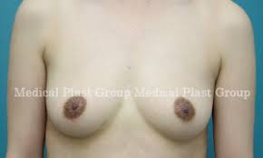 乳首　巨大|症例写真】巨大な女性化乳房の手術症例：美容外科 高須クリニック