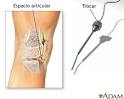En una <b>biopsia</b> sinovial se