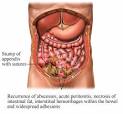 Straightfromthedoc: Schizophrenics and Ruptured Appendix