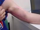 Michigan <b>Vascular</b> Access