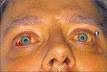 man with <b>Weil's disease</b>