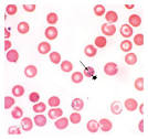 <b>Babesiosis</b> — NEJM