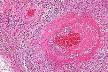 <b>Churg</b>-<b>Strauss syndrome</b>.