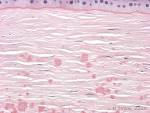 <b>Corneal Stromal</b> Dystrophies.