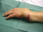 Gustilo open fracture classification - Orthopaedia Articles ...