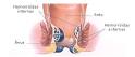 <b>Doenças</b> Perianais -