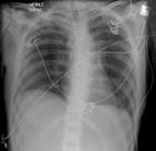 Radiology Picture of the Day » Archives » Trauma Chest Xray