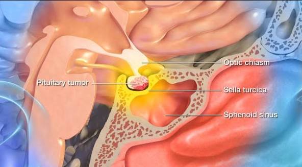 Pituitary Tumors | Barrow Neurological Institute