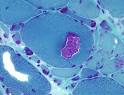 Inclusion body myositis definition with picture