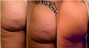 How To Get Rid Of Cellulite – Effective Cellulite Remedies, Tips ...