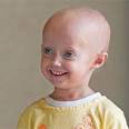 UNknow Author Tile:Progeria