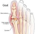 Gouty Arthritis Marijuana | California Pot | Medical Marijuana