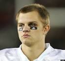 Jimmy Clausen Black Eye (
