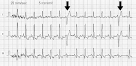 du <b>ventricule</b> droit.