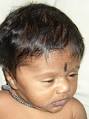 <b>Congenital Hypothyroidism</b> - A