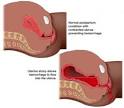 What is Blood Loss?
